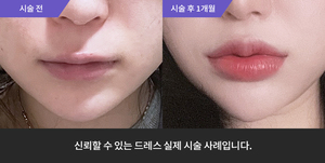 입술필러