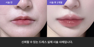 입술필러