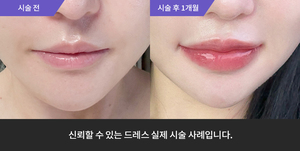 입술필러