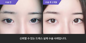 자연유착재수술 + 눈매교정재수술앞트위 + 윗트임