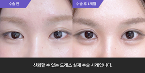 자연유착재수술 + 눈매교정