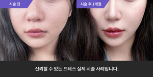 입술필러 + 코필러 +암살주사