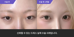 자연유착재수술 + 비절개눈매교정