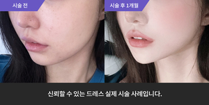 티타늄리프팅 + 암살주사