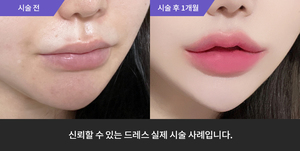 입술필러