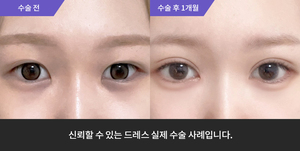 자연유착 + 눈매교정 + 앞트임 + 윗트임