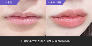 입술필러