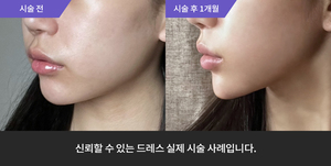 실리프팅 +  턱필러