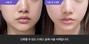 울쎄라 + 리쥬란힐러