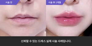 입술필러