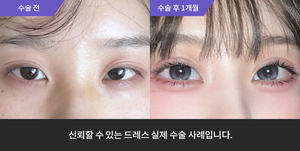 자연유착 + 눈매교정 + 앞트임 + 윗트임