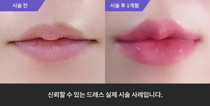 입술필러
