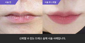 입술필러