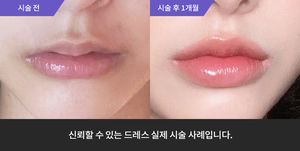 입술필러