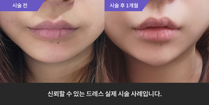 턱필러