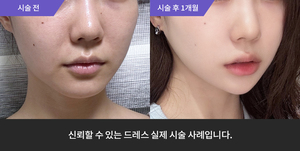 포텐자 + 리프테라