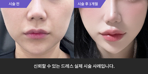 암살주사 + 입술필러