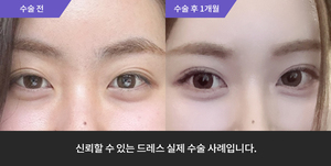 자연유착 + 눈매교정
