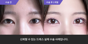 자연유착재수술 + 눈매교정 +뒤트임 + 밑트임