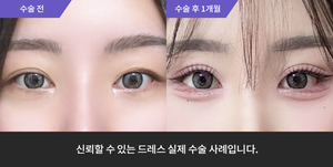 자연유착재수술 + 눈매교정