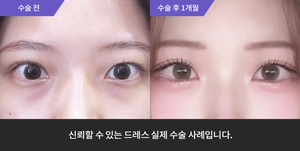 자연유착재수술 + 눈매교정