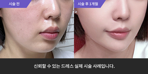 티타늄리프팅 + 턱필러
