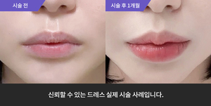 입술필러