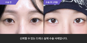 자연유착재수술 + 눈매교정재수술 + 뒤트임 + 밑트임