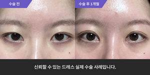 자연유착 + 눈매교정재수술 + 윗트임 + 뒤트임 재수술