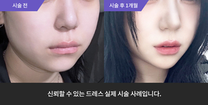티타늄 + 울쎄라