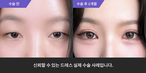자연유착재수술  + 눈매교정 + 윗트임