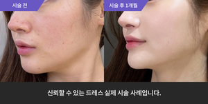 슈링크 + 엑소좀