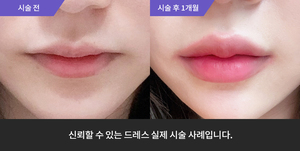 입술필러