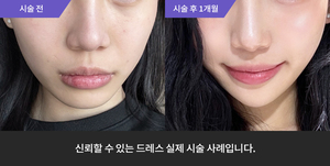 리프테라 + 엑소좀