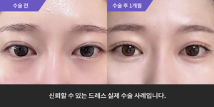 자연유착재수술 + 눈매교정 + 애교필러