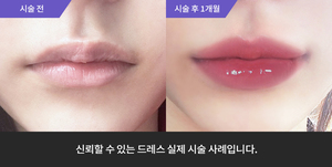 입술필러
