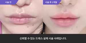 입술필러