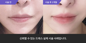 입술필러