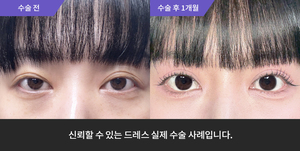 자연유착재수술 + 눈매교정