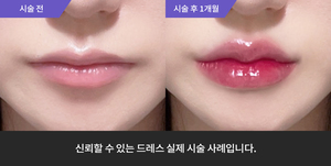 입술필러