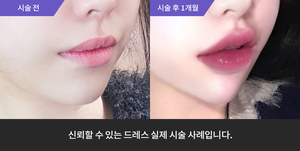 입술필러 + 턱필러