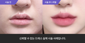 입술필러