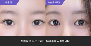 자연유착재수술  + 앞트임 + 윗트임