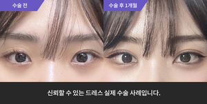 자연유착재수술+앞트임