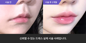 입술필러