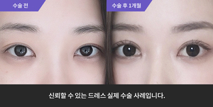 자연유착재수술 + 앞트임