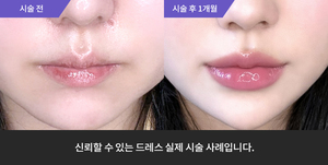 입술필러