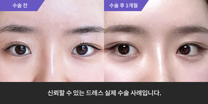 자연유착 + 앞트임 + 윗트임