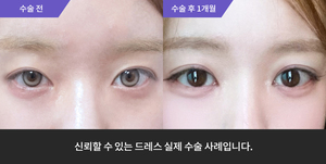 자연유착재수술 + 눈매교정 + 뒷트임 + 밑트임