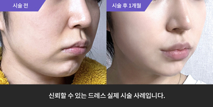 입술필러 + 울쎄라